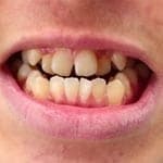 Denti storti