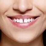 Grandi spazi tra i denti
