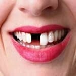 Mancanza di uno o piu denti